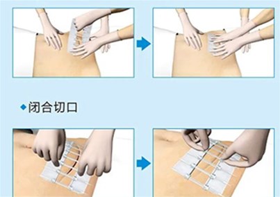 沭安泰?醫(yī)用皮膚減張閉合器